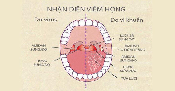 Chữa viêm họng bằng y học cổ truyền - Ảnh 2.