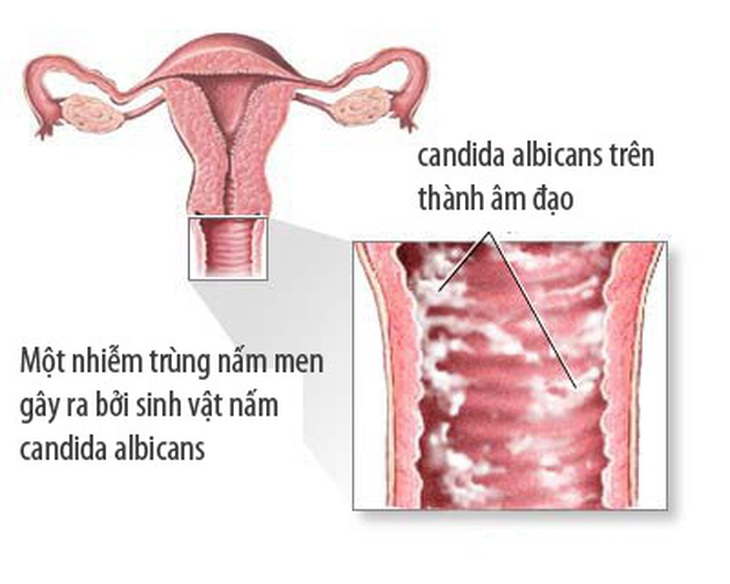 Có thể quan hệ tình dục khi đang nhiễm trùng âm đạo không? - Ảnh 3.