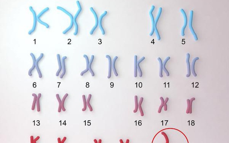 Bất thường nhiễm sắc thể - nguyên nhân di truyền phổ biến gây dị tật bẩm sinh