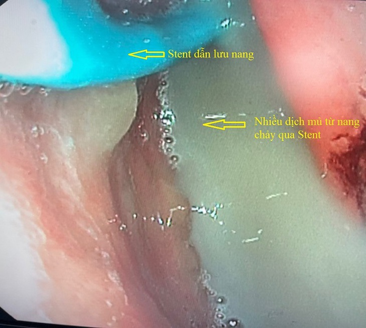 Sỏi đường mật, không điều trị sớm hậu quả khó lường - Ảnh 1. Sỏi đường mật, không điều trị sớm hậu quả khó lường - Ảnh 1.