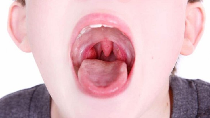 Các dạng viêm họng thường gặp - Ảnh 1. Các dạng viêm họng thường gặp - Ảnh 1.