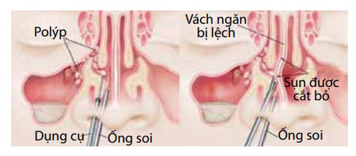Phẫu thuật xoang mũi: Ưu điểm và những điều cần biết - Ảnh 1. Phẫu thuật xoang mũi: Ưu điểm và những điều cần biết - Ảnh 1.