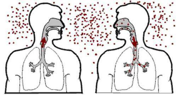 Lao kê: Triệu chứng, mức độ nguy hiểm và cách điều trị, phòng ngừa - Ảnh 5. Lao kê: Triệu chứng, mức độ nguy hiểm và cách điều trị, phòng ngừa - Ảnh 5.