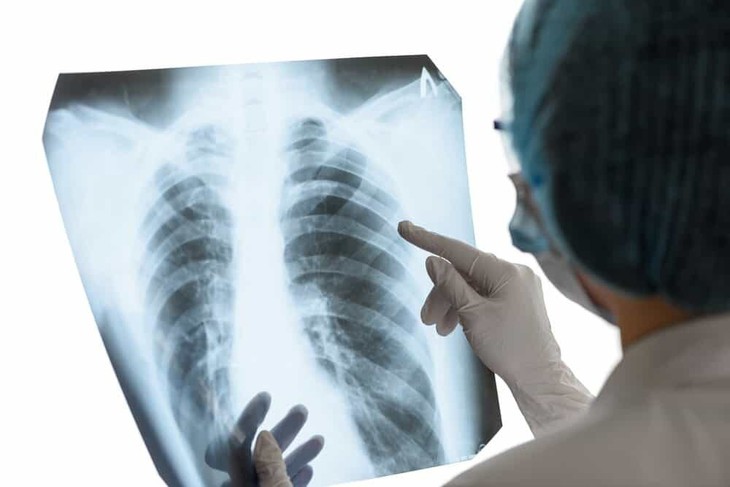 Lao kê: Triệu chứng, mức độ nguy hiểm và cách điều trị, phòng ngừa - Ảnh 3. Lao kê: Triệu chứng, mức độ nguy hiểm và cách điều trị, phòng ngừa - Ảnh 3.
