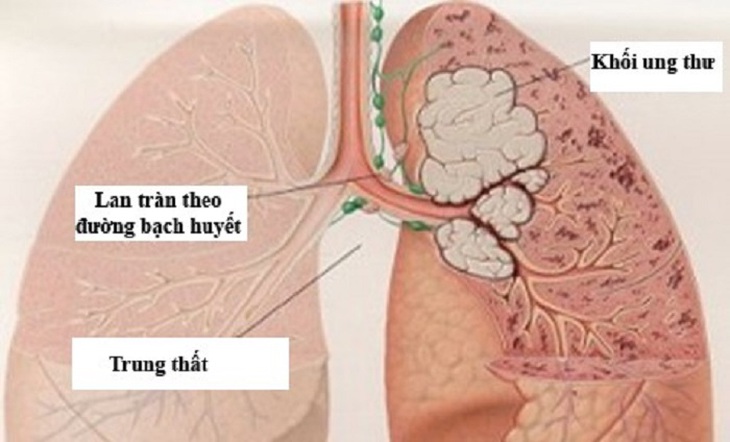 Các phương pháp điều trị ung thư phổi hiện nay ra sao? - Ảnh 1.