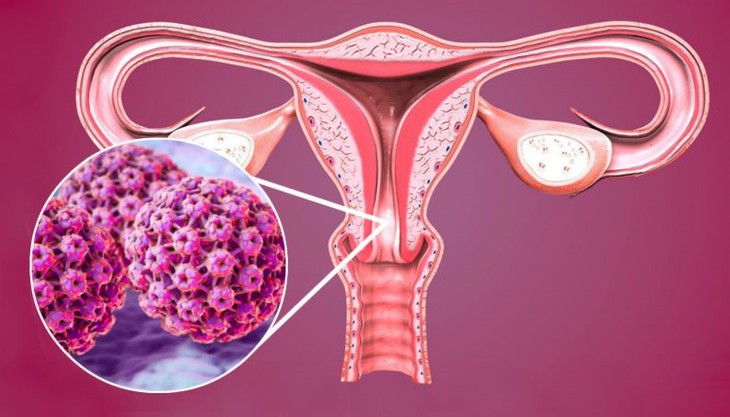 Tự thu mẫu HPV - Giải pháp sàng lọc ung thư cổ tử cung tại nhà - Ảnh 1. Tự thu mẫu HPV - Giải pháp sàng lọc ung thư cổ tử cung tại nhà - Ảnh 1.