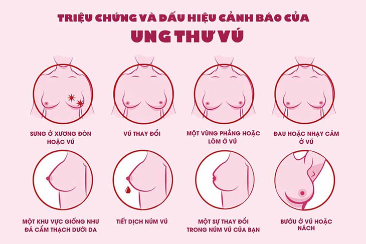 Các giai đoạn của ung thư vú và cách điều trị - Ảnh 4.