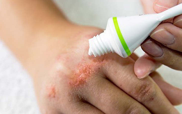 Viêm da cơ địa - Bác sĩ chỉ cách dùng thuốc an toàn
