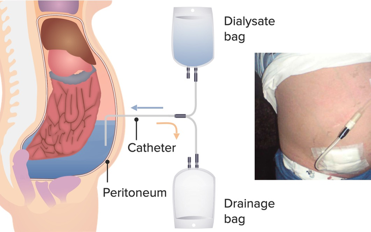 Lọc màng bụng - Giải pháp cho người suy thận mùa dịch?