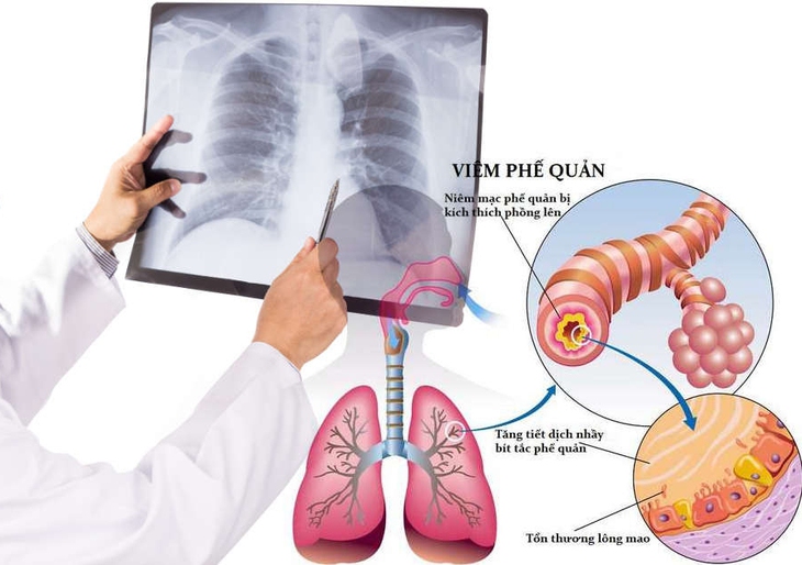 Thuốc điều trị viêm phế quản - Ảnh 1. Thuốc điều trị viêm phế quản - Ảnh 1.