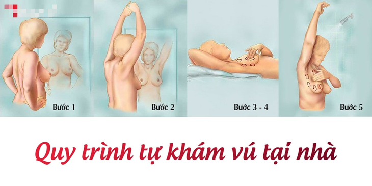 Các giai đoạn của ung thư vú và cách điều trị - Ảnh 5.
