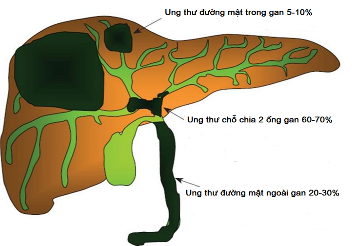 Ung thư đường mật: Triệu chứng, phân loại và nguyên nhân gây bệnh ai cũng cần phải biết - Ảnh 1. Ung thư đường mật: Triệu chứng, phân loại và nguyên nhân gây bệnh ai cũng cần phải biết - Ảnh 1.