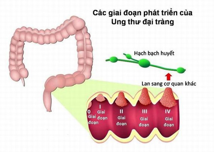 Làm thế nào để phòng và phát hiện ung thư đại trực tràng? - Ảnh 1. Làm thế nào để phòng và phát hiện ung thư đại trực tràng? - Ảnh 1.