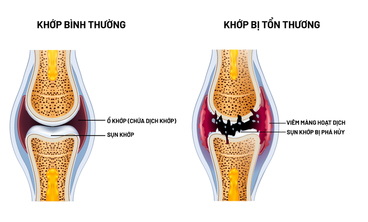 Khám phá mới về nguyên nhân và cách cải thiện bệnh xương khớp - Ảnh 2.