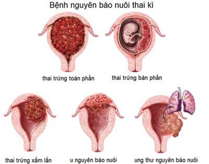 U50 gặp các dấu hiệu mang thai, đi khám mới biết mình chửa trứng - Ảnh 1.