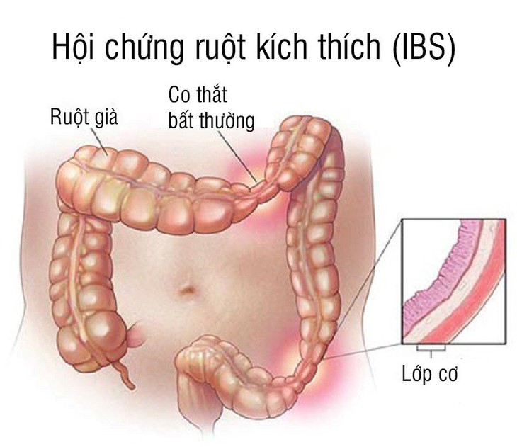 Hội chứng ruột kích thích làm gì để cải thiện và hạn chế tái phát? - Ảnh 1.