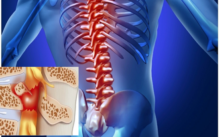 Sau tổn thương tủy sống - Phương pháp giúp người bệnh kiểm soát cơn đau, hòa nhập cộng đồng