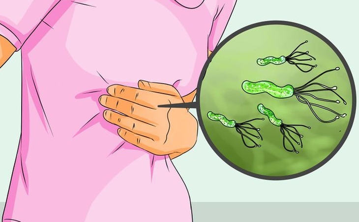 Vi khuẩn Helicobacter pylori và ung thư dạ dày - Ảnh 4.