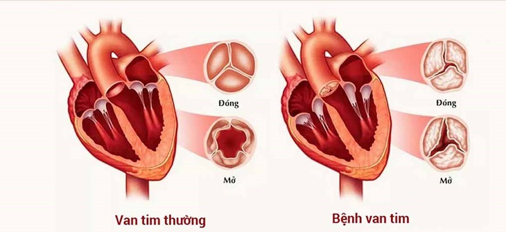 Hở van tim hai lá: Nguyên nhân, triệu chứng, biến chứng và phương pháp điều trị - Ảnh 1.