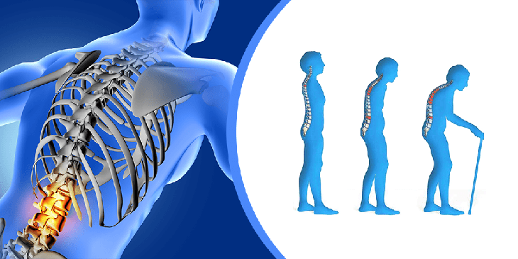 Loãng xương và những lưu ý khi dùng thuốc điều trị - Ảnh 1. Loãng xương và những lưu ý khi dùng thuốc điều trị - Ảnh 1.