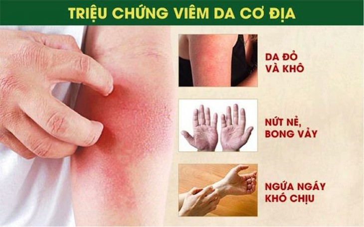 Bí quyết làm dịu mát da từ thảo dược thiên nhiên cho người bị viêm da - Ảnh 1. Bí quyết làm dịu mát da từ thảo dược thiên nhiên cho người bị viêm da - Ảnh 1.