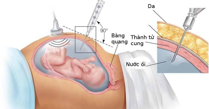 Vì sao thai phụ cần làm các xét nghiệm sàng lọc trước sinh? - Ảnh 4.