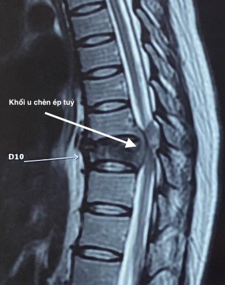 Trả lại chức năng vận động cho một bệnh nhân trẻ bị u thân sống - Ảnh 2.