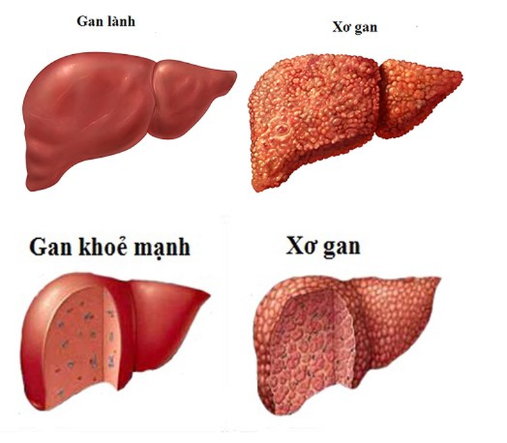 Thuốc lá và bệnh gan: tưởng không liên quan nhưng gây nhiều bệnh nguy hiểm - Ảnh 2.