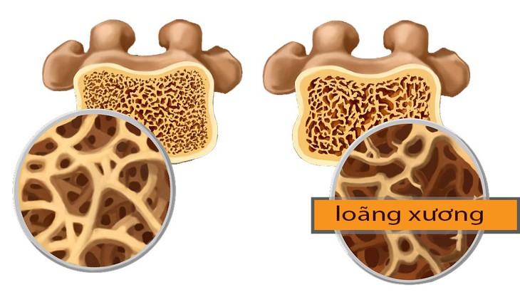 Nhận biết sớm nguy cơ và dấu hiệu bệnh loãng xương - Ảnh 2.