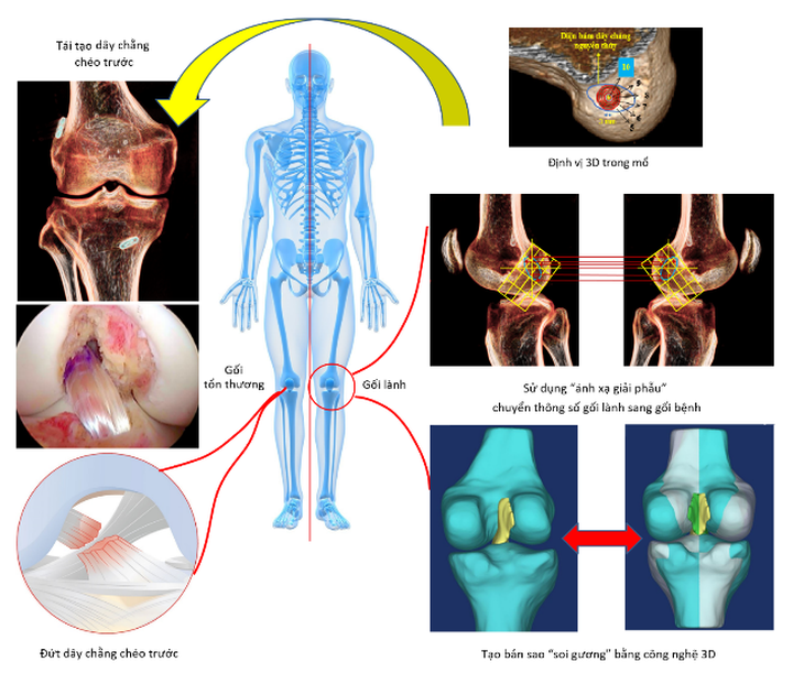 Vinmec tái tạo chính xác dây chằng chéo trước khớp gối với phương pháp "ánh xạ giải phẫu" độc quyền - Ảnh 3.