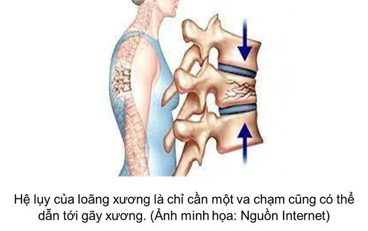 Nhận biết sớm nguy cơ và dấu hiệu bệnh loãng xương - Ảnh 3.