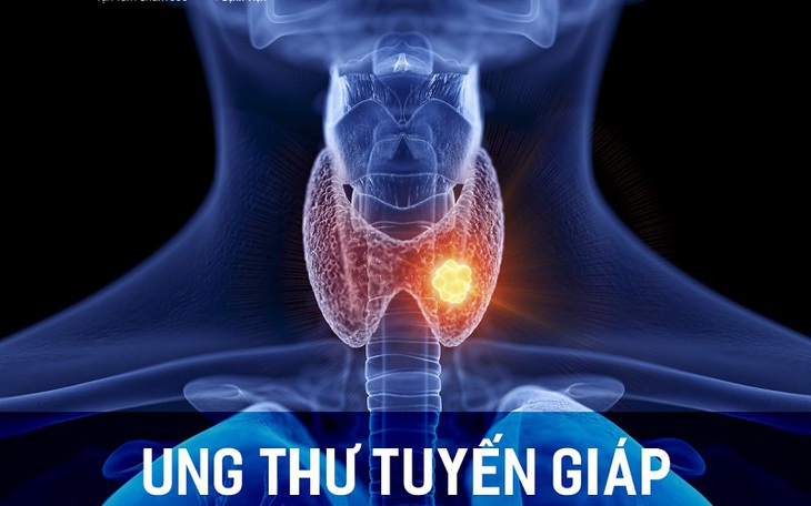 Ung thư tuyến giáp: Phương pháp điều trị, tiên lượng sống và theo dõi nguy cơ