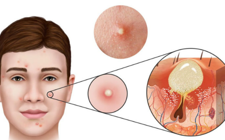Mụn trứng cá: Nguyên nhân và thuốc điều trị