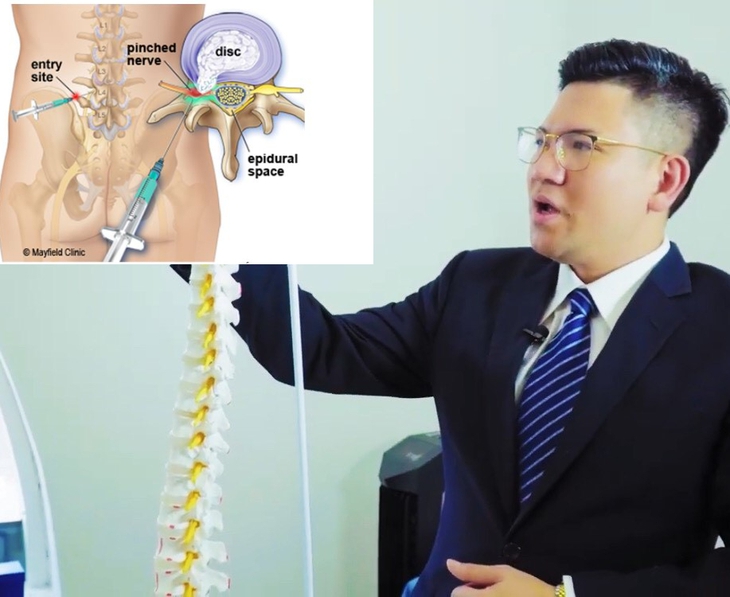 Mắc các bệnh lý về cột sống – khi nào cần tiêm steroid ngoài màng cứng tủy - Ảnh 1. Mắc các bệnh lý về cột sống – khi nào cần tiêm steroid ngoài màng cứng tủy - Ảnh 1.