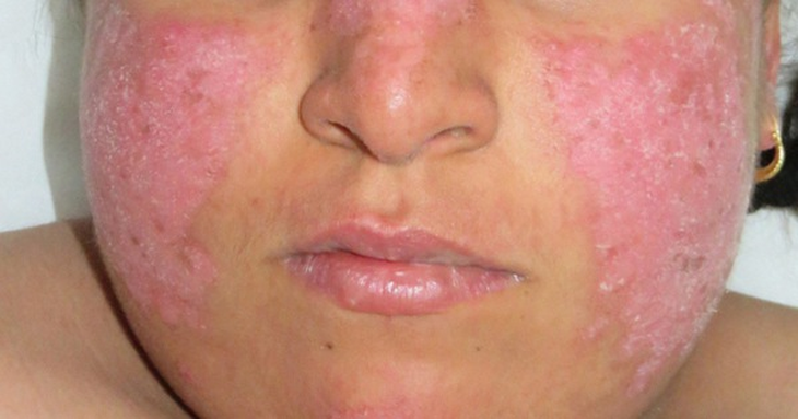 Tăng cường miễn dịch hỗ trợ người bệnh tự miễn như lupus ban đỏ - Ảnh 1. Tăng cường miễn dịch hỗ trợ người bệnh tự miễn như lupus ban đỏ - Ảnh 1.