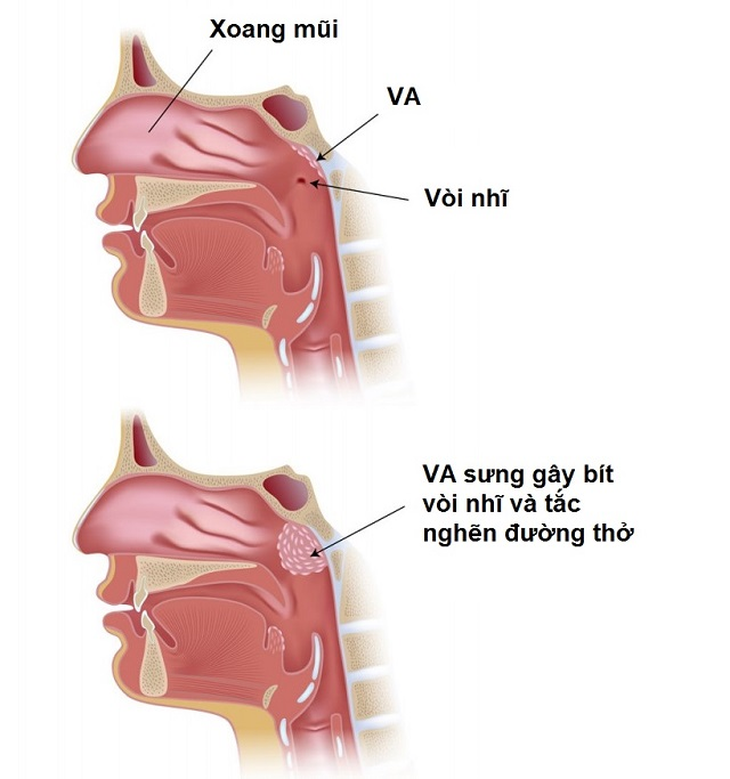 Nạo VA ảnh hưởng như thế nào tới vòi tai? - Ảnh 6. Nạo VA ảnh hưởng như thế nào tới vòi tai? - Ảnh 6.
