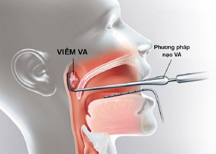 Nạo VA ảnh hưởng như thế nào tới vòi tai? - Ảnh 4. Nạo VA ảnh hưởng như thế nào tới vòi tai? - Ảnh 4.