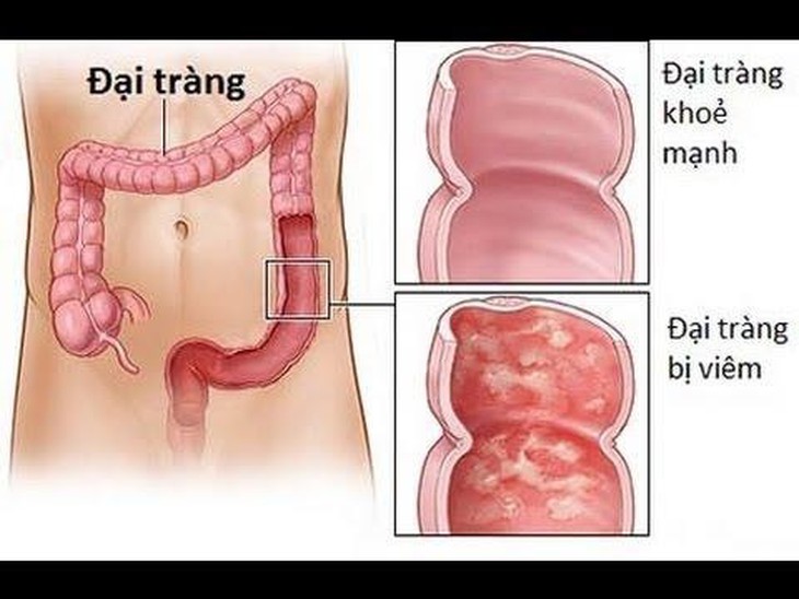 Bệnh viêm loét đại tràng ảnh hưởng thế nào đến thai kỳ? - Ảnh 2.