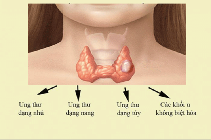 Ung thư tuyến giáp: Sự phát triển của khối u và chẩn đoán mô bệnh học - Ảnh 1.