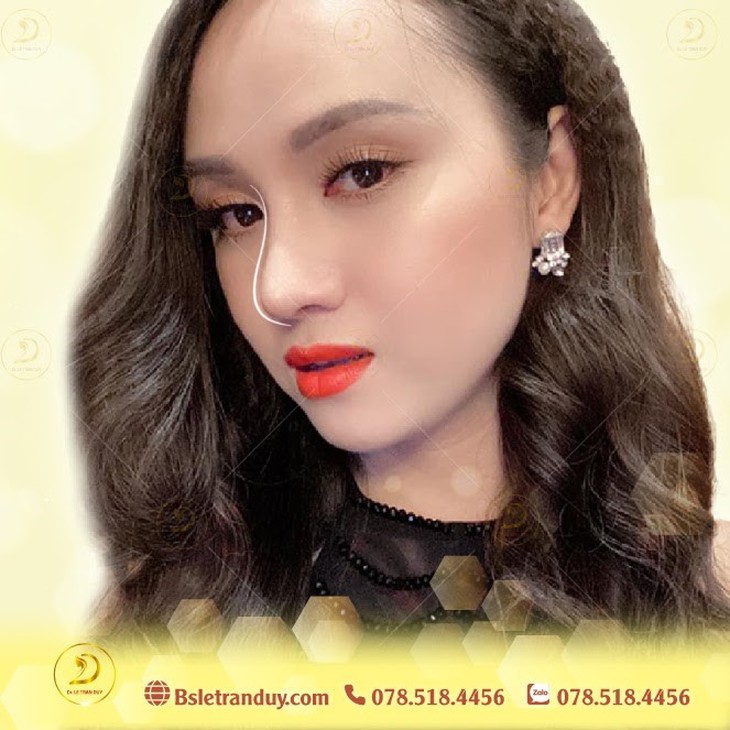 gia nang mui bảng giá nâng mũi 