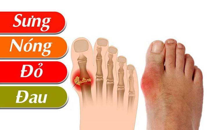 Bệnh gút (gout) và cách phòng ngừa, điều trị hiệu quả - Ảnh 5.