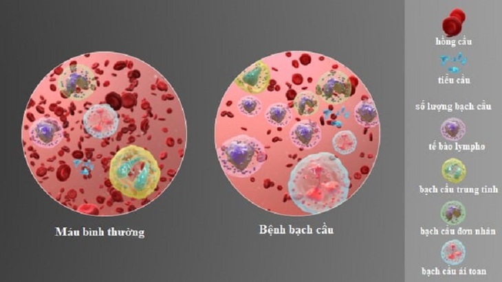 Những điều cần biết về ung thư trẻ em - Ảnh 2.