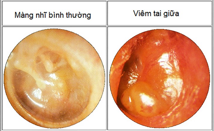Viêm tai giữa ở trẻ em mùa lạnh: Cách phát hiện, chẩn đoán và phòng tránh như nào? - Ảnh 3. Viêm tai giữa ở trẻ em mùa lạnh: Cách phát hiện, chẩn đoán và phòng tránh như nào? - Ảnh 3.