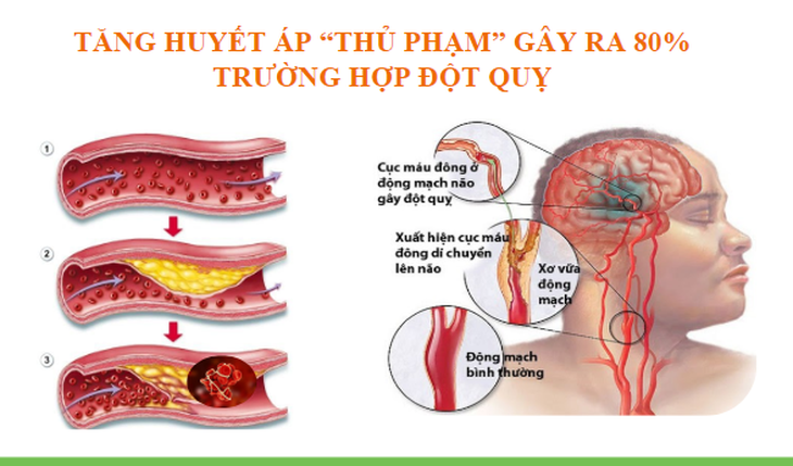 Báo động nguy cơ đột quỵ ở những người huyết áp cao - Ảnh 2.