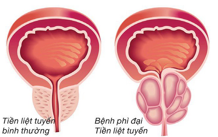 Đề phòng biến chứng của u xơ tiền liệt tuyến - Ảnh 2. Đề phòng biến chứng của u xơ tiền liệt tuyến - Ảnh 2.