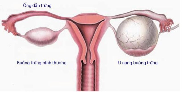 U nang buồng trứng nguy hiểm thế nào? - Ảnh 1.