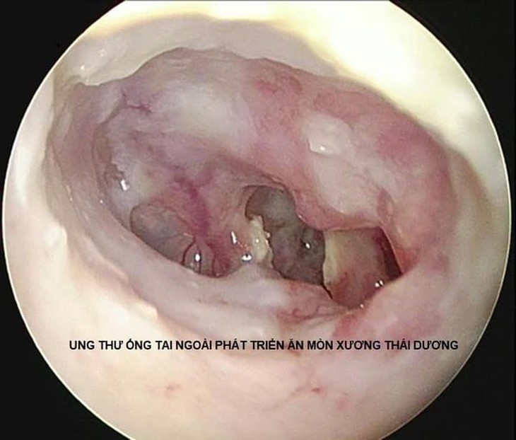 Ung thư ống tai ngoài: Triệu chứng, chẩn đoán và điều trị - Ảnh 2.