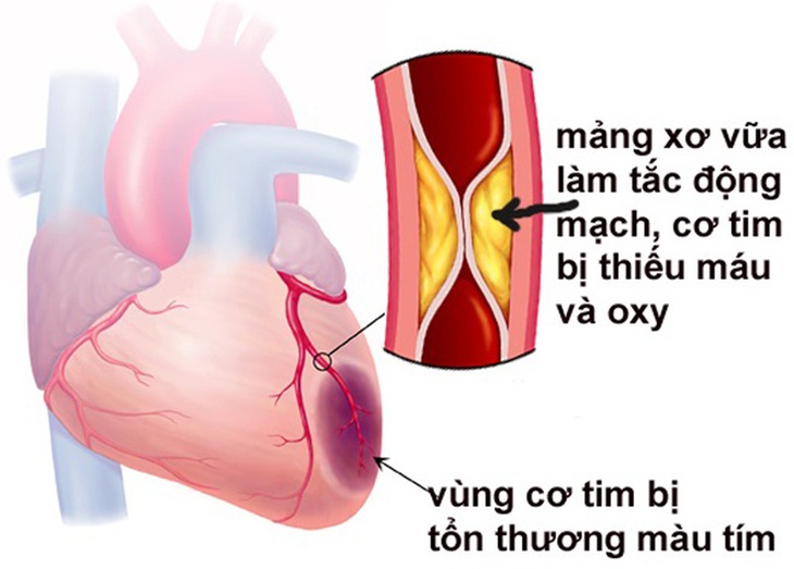 Một số yếu tố nguy cơ gây bệnh tim mạch mà ai cũng cần phải biết - Ảnh 3.