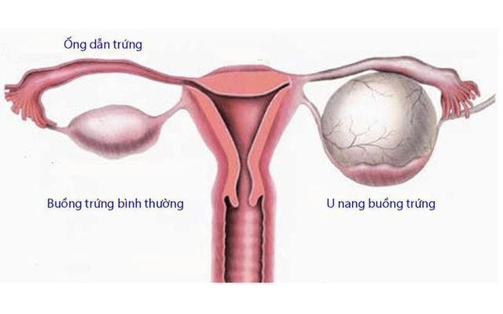 U nang buồng trứng nguy hiểm thế nào?