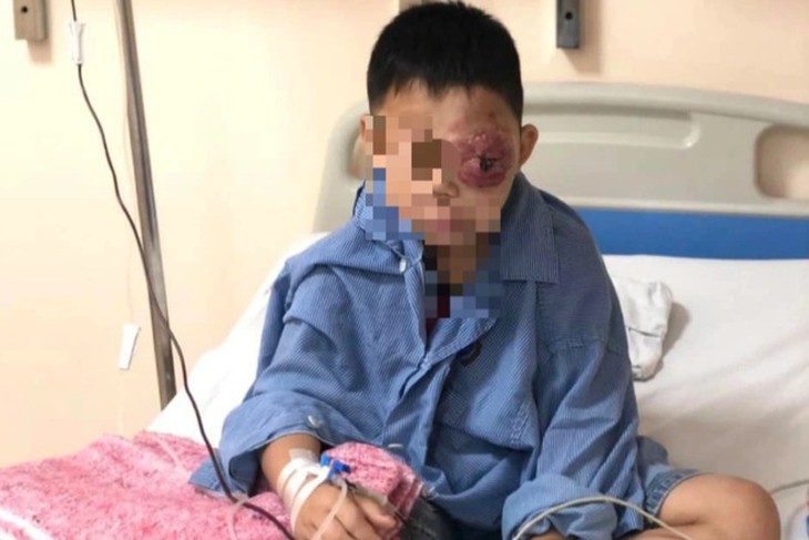 Cậu bé có khối u "khủng" ở mắt trái đã khóc khi nhìn thấy mẹ sau ca phẫu thuật thành công - Ảnh 1.